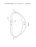 PERCUTANEOUS TRANSCATHETER REPAIR OF HEART VALVES VIA TRANS-APICAL ACCESS diagram and image