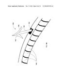 PERCUTANEOUS TRANSCATHETER REPAIR OF HEART VALVES VIA TRANS-APICAL ACCESS diagram and image