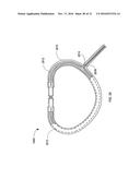 PERCUTANEOUS TRANSCATHETER REPAIR OF HEART VALVES VIA TRANS-APICAL ACCESS diagram and image