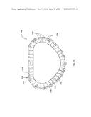 PERCUTANEOUS TRANSCATHETER REPAIR OF HEART VALVES VIA TRANS-APICAL ACCESS diagram and image