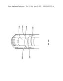 PERCUTANEOUS TRANSCATHETER REPAIR OF HEART VALVES VIA TRANS-APICAL ACCESS diagram and image