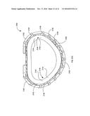 PERCUTANEOUS TRANSCATHETER REPAIR OF HEART VALVES VIA TRANS-APICAL ACCESS diagram and image