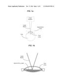 PHOTODISRUPTIVE LASER FRAGMENTATION OF TISSUE diagram and image