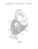 CARDIAC TREATMENT SYSTEM diagram and image