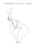 NEEDLE FOR A MINIMALLY INVASIVE SURGICAL SUTURING DEVICE diagram and image