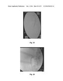 THIXOTROPIC OXIDIZED CELLULOSE SOLUTIONS AND MEDICAL APPLICATIONS THEREOF diagram and image