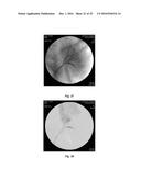 THIXOTROPIC OXIDIZED CELLULOSE SOLUTIONS AND MEDICAL APPLICATIONS THEREOF diagram and image