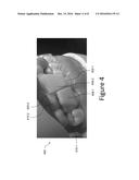 DENTAL APPLIANCE BINDING STRUCTURE diagram and image