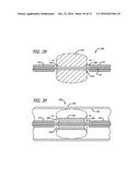 DEVICES FOR THERAPEUTIC VASCULAR PROCEDURES diagram and image