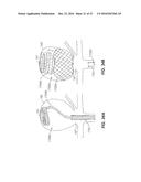 DEVICES FOR THERAPEUTIC VASCULAR PROCEDURES diagram and image