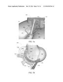 ADAPTIVE SURFACE SURGICAL GUIDING APPARATUSES INCLUDING STABILITY AND/OR     VERIFICATION ELEMENTS diagram and image