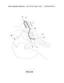 Tongue anteriorizer and method of operating same diagram and image