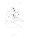 Tongue anteriorizer and method of operating same diagram and image