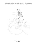Tongue anteriorizer and method of operating same diagram and image