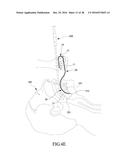 Tongue anteriorizer and method of operating same diagram and image