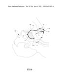 Tongue anteriorizer and method of operating same diagram and image