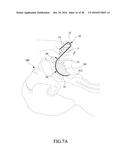 Tongue anteriorizer and method of operating same diagram and image