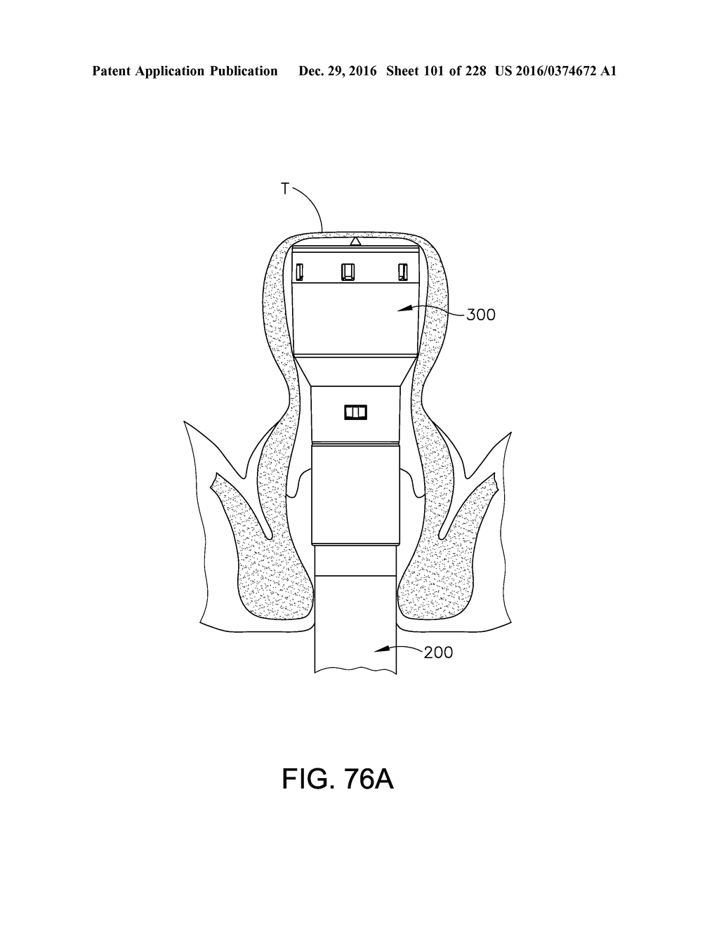 METHOD OF APPLYING AN ANNULAR ARRAY OF STAPLES TO TISSUE - diagram, schematic, and image 102