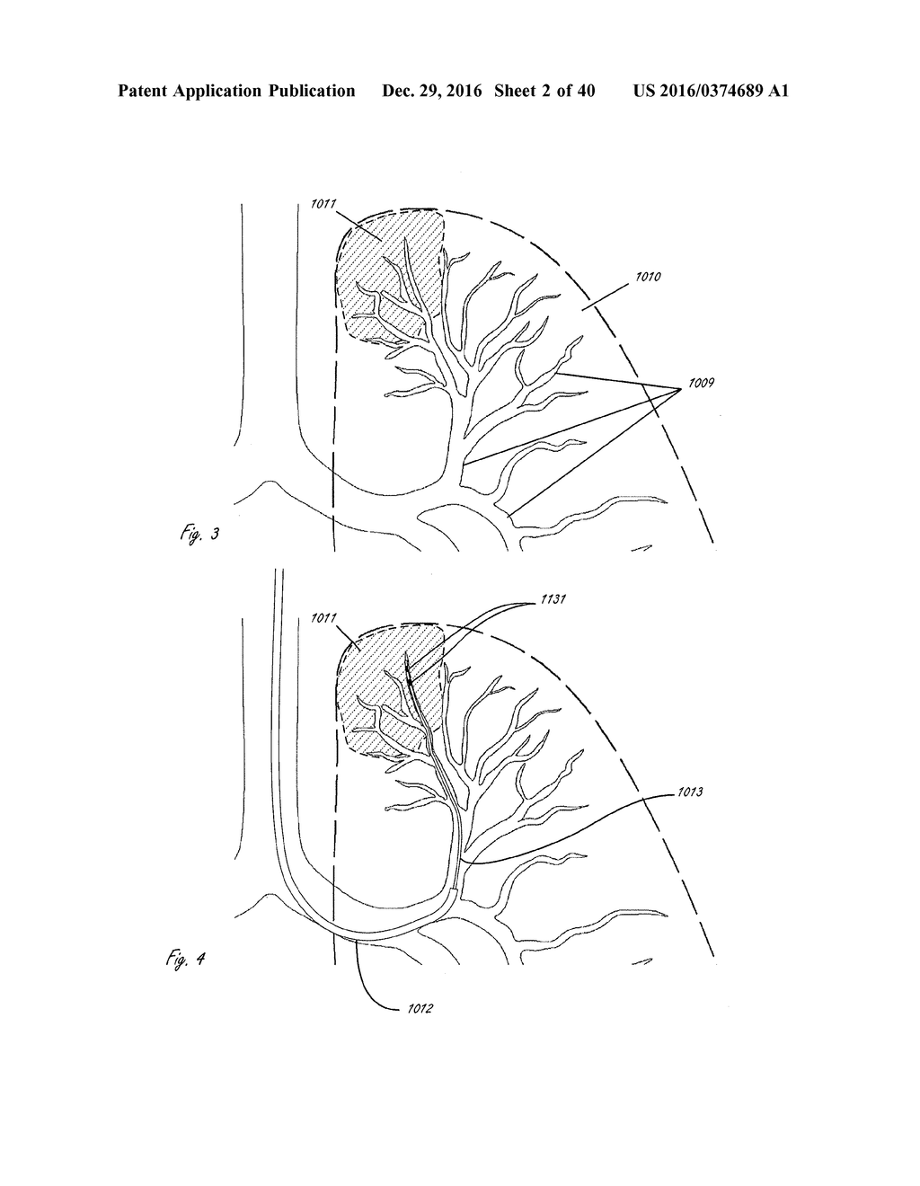 DEVICES AND METHODS FOR LUNG VOLUME REDUCTION - diagram, schematic, and image 03