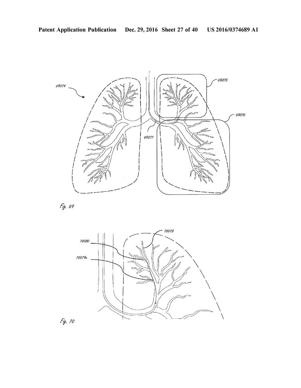 DEVICES AND METHODS FOR LUNG VOLUME REDUCTION - diagram, schematic, and image 28