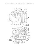 Patient-Specific Humeral Guide Designs diagram and image