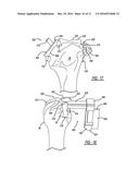 Patient-Specific Humeral Guide Designs diagram and image