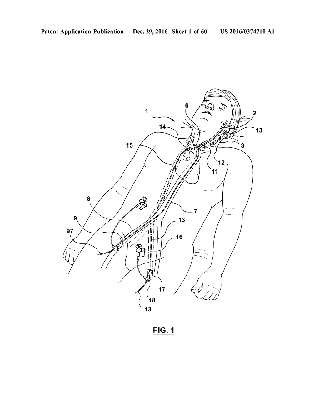 CAROTID BODY ABLATION WITH A TRANSVENOUS ULTRASOUND IMAGING AND ABLATION     CATHETER - diagram, schematic, and image 02