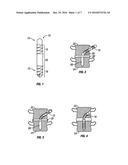 Distraction Screw diagram and image