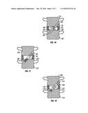 Distraction Screw diagram and image