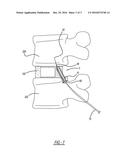 RETRACTABLE SCREW GUIDE diagram and image