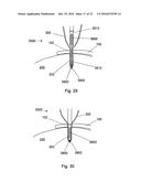 MULTIPLE IMPLANT CONSTRUCTIONS AND FIXATION METHODS ASSOCIATED THEREWITH diagram and image