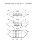 PROSTHETIC HEART VALVE diagram and image