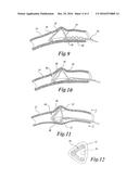 TISSUE SHAPING DEVICE diagram and image