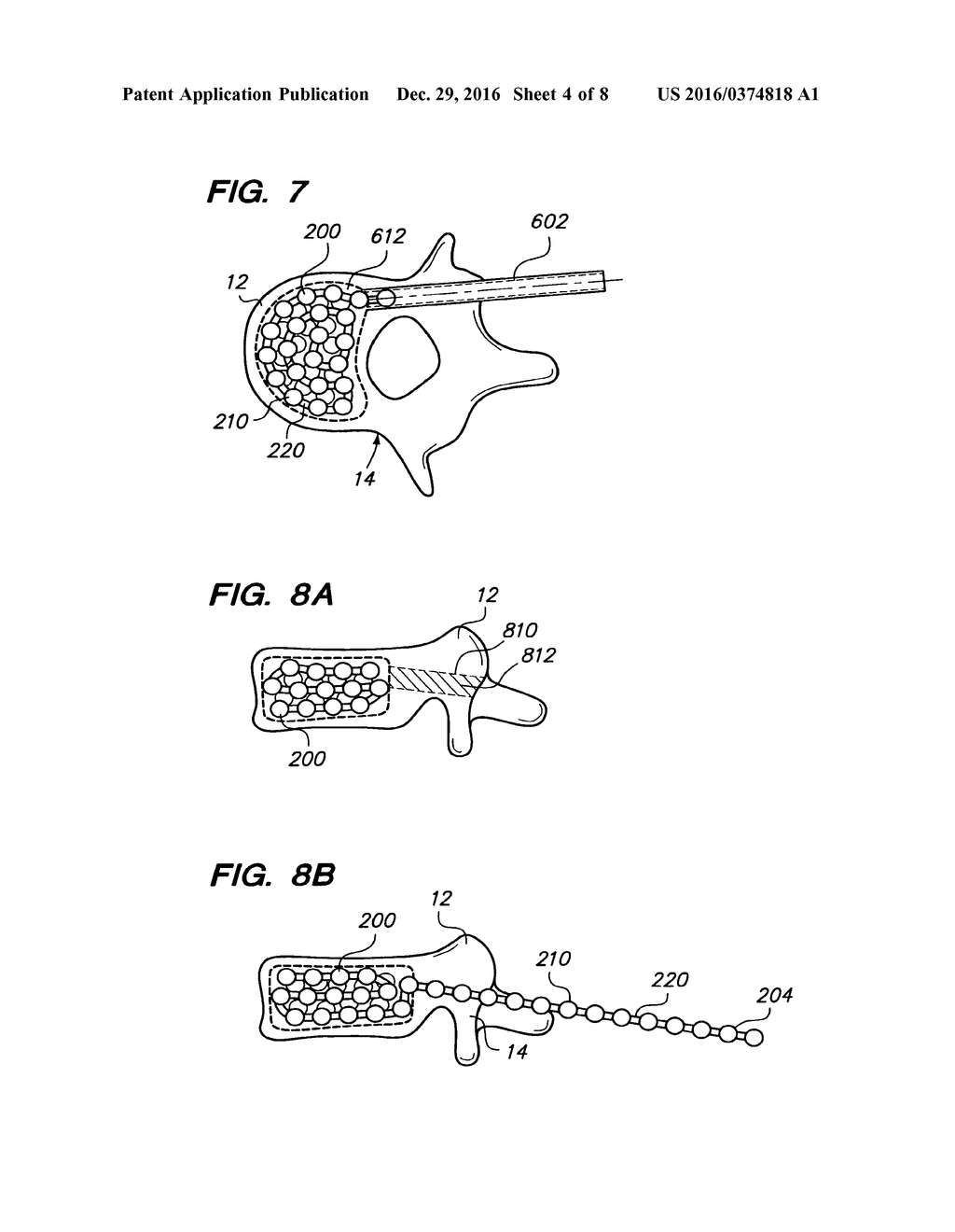 FLEXIBLE ELONGATED CHAIN IMPLANT AND METHOD OF SUPPORTING BODY TISSUE WITH     SAME - diagram, schematic, and image 05
