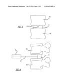 MODULAR INTERBODY ALIGNMENT DEVICE diagram and image