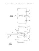 MODULAR INTERBODY ALIGNMENT DEVICE diagram and image