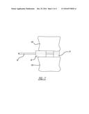 MODULAR INTERBODY ALIGNMENT DEVICE diagram and image