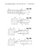 PROSTHESIS DELIVERY DEVICE diagram and image