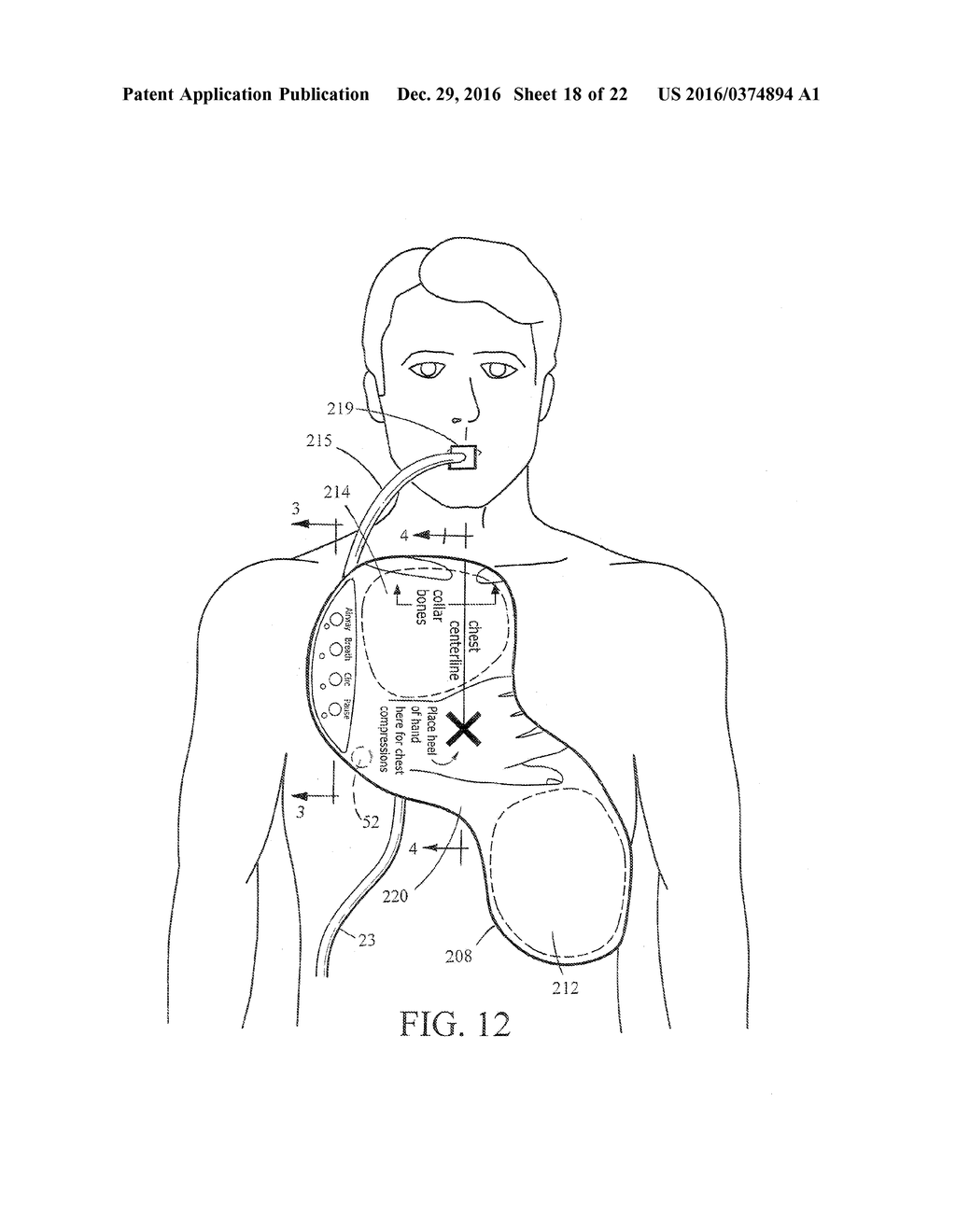 Automated Resuscitation Device with Ventilation Sensing and Prompting - diagram, schematic, and image 19