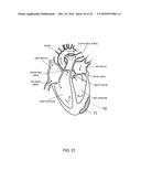 AMNION DERIVED THERAPEUTIC COMPOSITIONS AND METHODS OF USE diagram and image