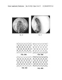 IMPLANTABLE SCAFFOLDS FOR TREATMENT OF SINUSITIS diagram and image