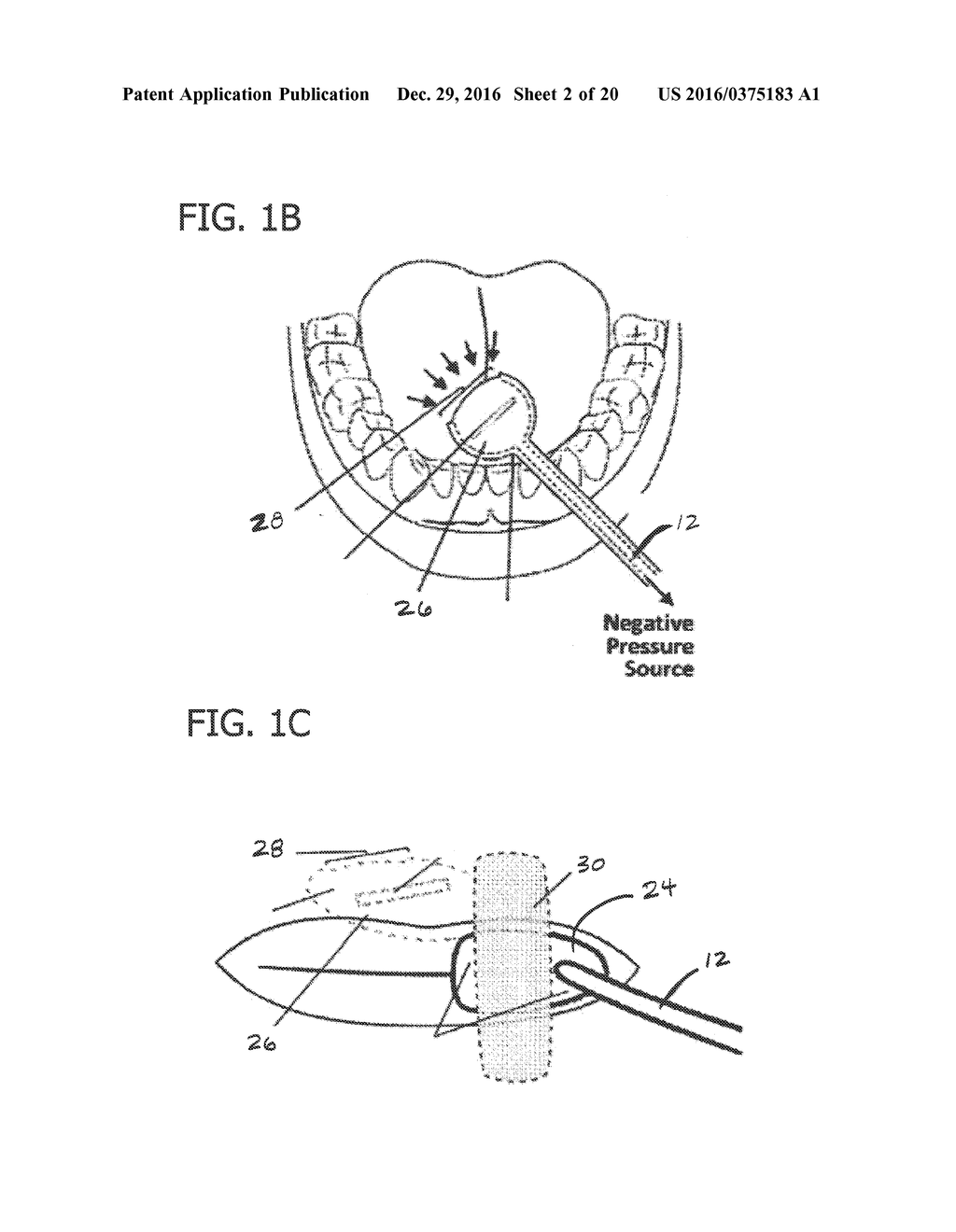 LIQUID CONTAINER AND ABSORBENT INSERT FOR ORAL NEGATIVE-PRESSURE THERAPY     SYSTEM - diagram, schematic, and image 03