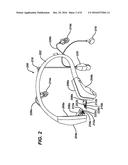 PERSONALIZABLE SYSTEM AND METHOD FOR ANESTHETIZING THE TYMPANIC MEMBRANE diagram and image