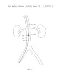 DEVICES AND METHODS FOR TREATING ACUTE KIDNEY INJURY diagram and image
