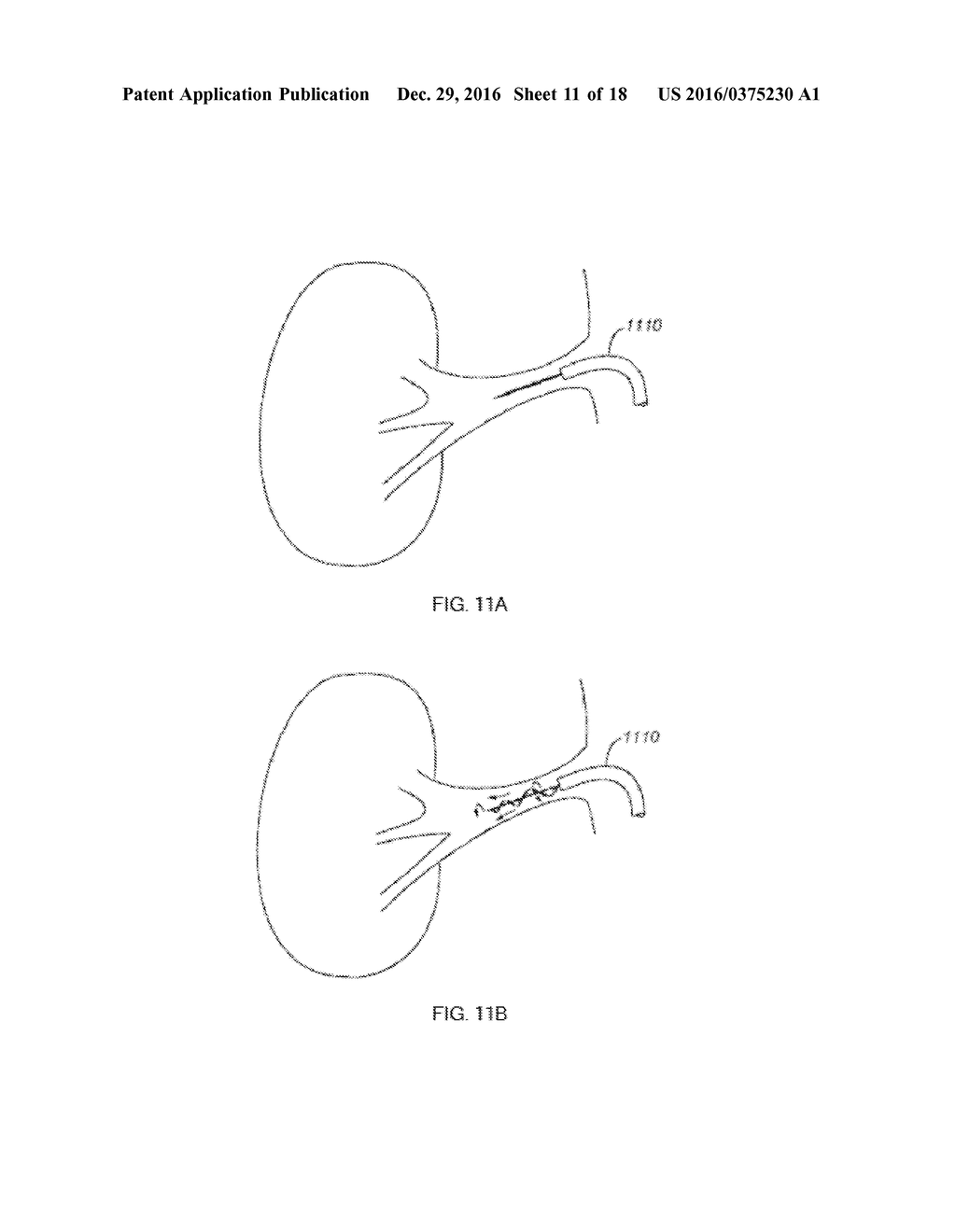 DEVICES AND METHODS FOR TREATING ACUTE KIDNEY INJURY - diagram, schematic, and image 12