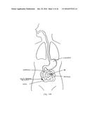 DEVICES AND METHODS FOR TREATING THE GASTROINTESTINAL SYSTEM diagram and image