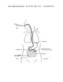 DEVICES AND METHODS FOR TREATING THE GASTROINTESTINAL SYSTEM diagram and image