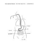 DEVICES AND METHODS FOR TREATING THE GASTROINTESTINAL SYSTEM diagram and image