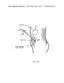 DEVICES AND METHODS FOR TREATING THE GASTROINTESTINAL SYSTEM diagram and image