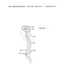 METHODS AND SYSTEM FOR ULTRASONIC TARGETED DRUG DELIVERY IN CYSTIC FLUIDS,     SUCH AS THE CEREBROSPINAL FLUID, USING BUOYANCY SPECIFIC DRUG CARRIERS diagram and image